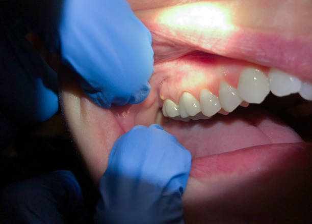 Best Emergency Root Canal Treatment in Teays Valley, WV